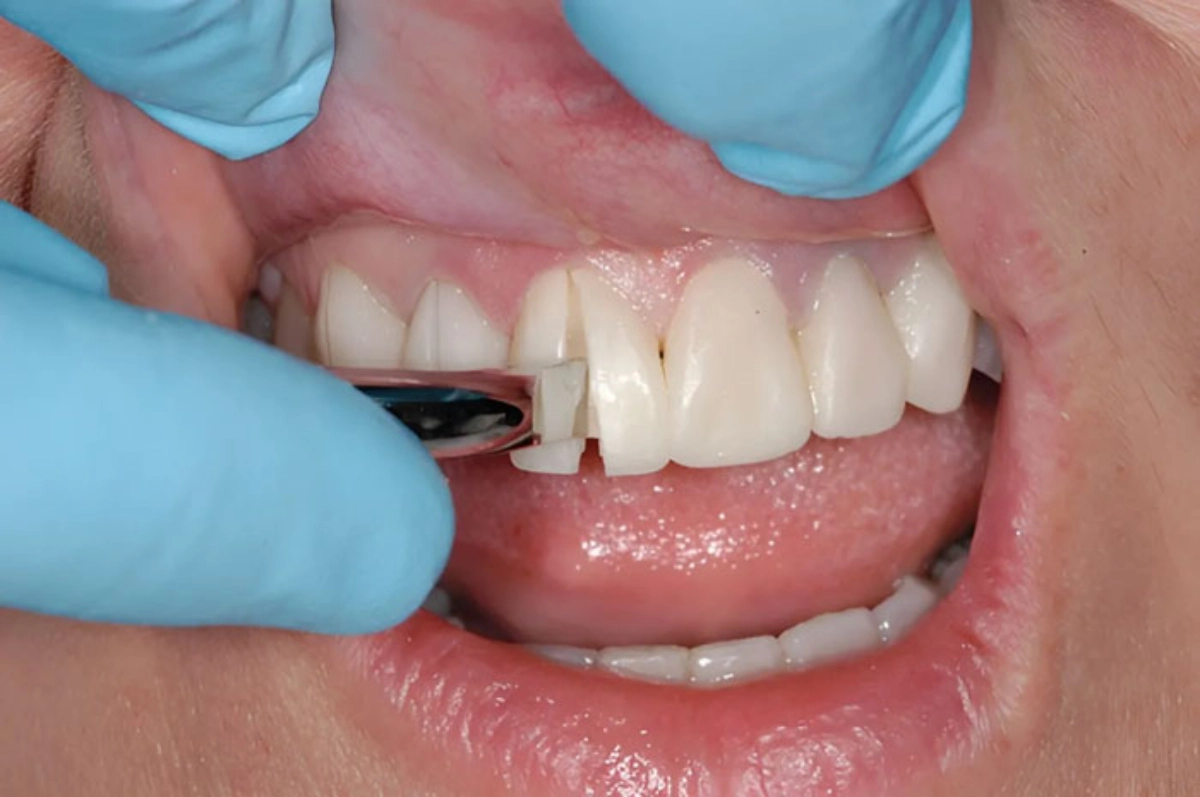 Dựa trên tình trạng thực tế, bác sĩ sẽ lựa chọn kỹ thuật tháo răng sứ an toàn